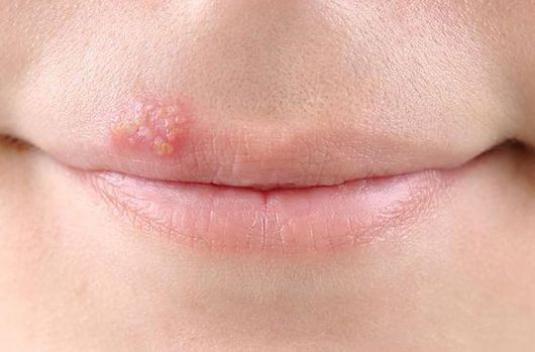 Kā ārstēt herpes lūpām?